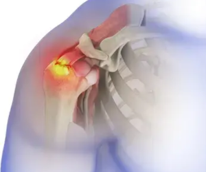 Rotator Cuff Repair Surgery in Mumbai by Dr. Chintan Desai